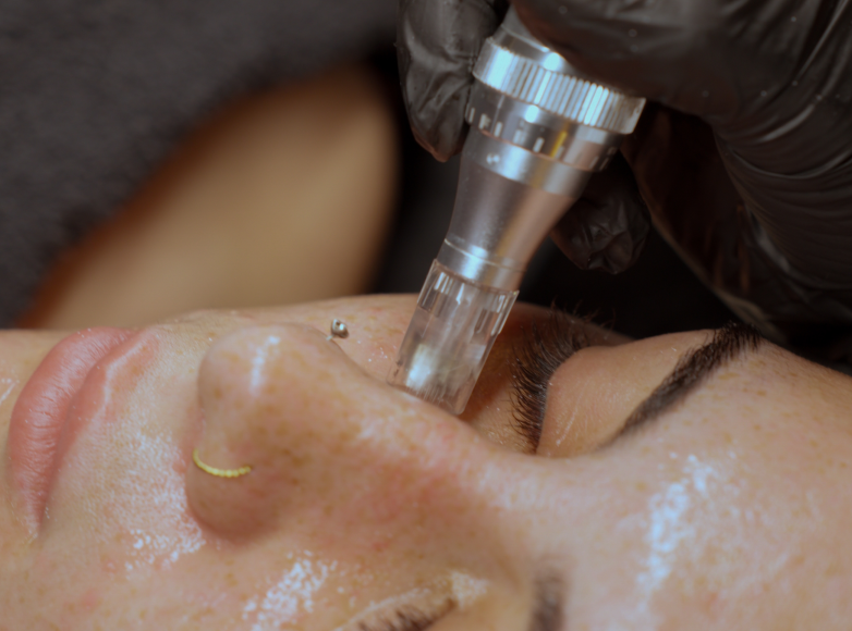 Professionelles Microneedling zur Hautverjüngung und Behandlung von Pigmentflecken bei Bahia Beauty Brasil in Nürnberg Nordstadt.