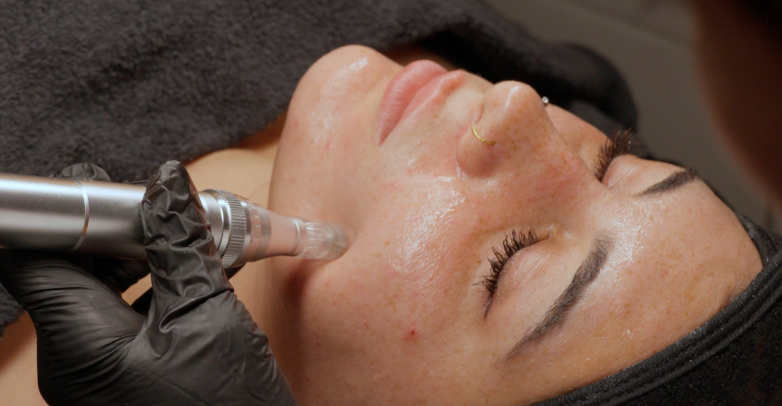 Hautstraffung durch Microneedling mit Radiofrequenz bei Bahia Beauty Brasil Nürnberg