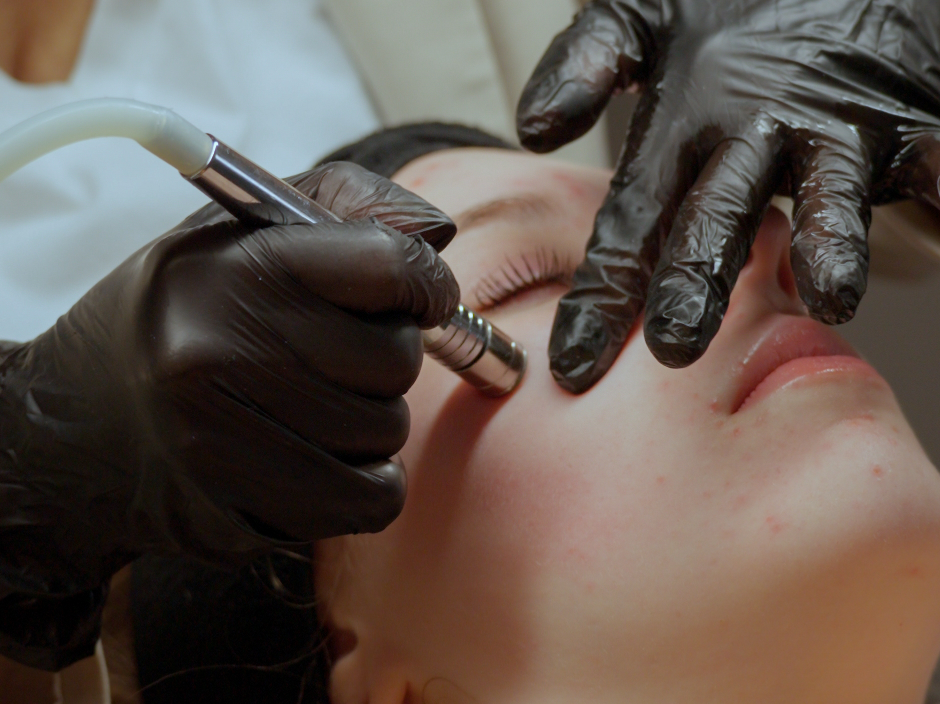 Professionelle Mikrodermabrasion mit Diamantkopf und Ultraschall-Hyaluron-Einschleusung bei Bahia Beauty Brasil in Nürnberg Nordstadt.